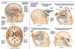 Brain Surgery - Traumatic Brain Injuries with Craniotomy and Drainage of Blood Clot