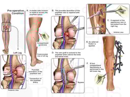 Left Leg Injuries with Surgical Procedures