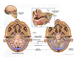 Acoustic Neuroma