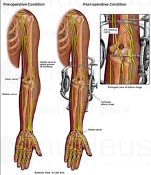 Placement of External Fixator with Subsequent Damage to the Radial Nerve