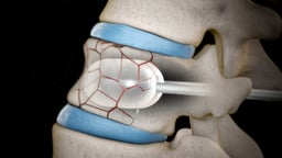 Vertebroplasty and Kyphoplasty