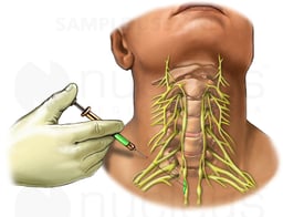 Anterior Cervical Nerve Block