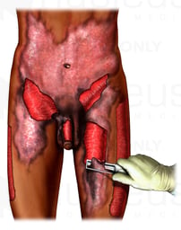 Severe Burn Debridement