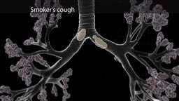 Smoker's Cough: Mucus Accumulation in Bronchi