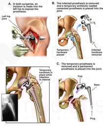 Left Hip Revision Surgeries