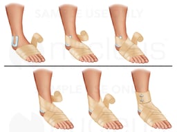 Ace Bandage Appication-Sprained Ankle
