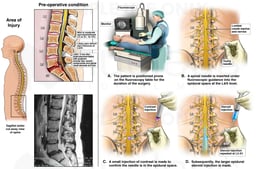 severe compromise and spinal canal stenosis