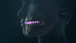 Stabilization Splint in Oral Cavity