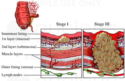 Colon Cancer - Stages I and III