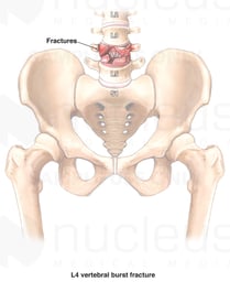 Lumbar Spine Fractures Causing Nerve Damage
