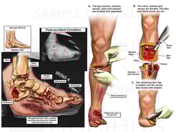Left Leg Injury with Surgical Amputation