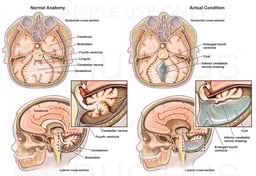Evidence of Dandy Walker Variant
