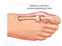 Hallux Rigidus