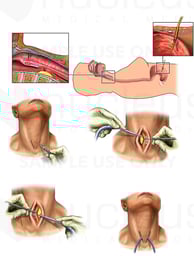 Esophageal Perforation/Tear with Surgical PEG Placement and Bilateral Neck Drainage