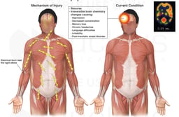 Electrical Injury with Permanent Deficits