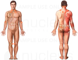 Fibromyalgia Syndrome (Male)