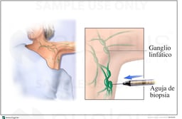 Needle Lymph Biopsy