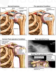 Surgical Decompression of the Shoulder with Excessive Clavicle Resection