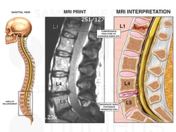 MRI Illustration Depicting Traumatic Injury to the Lumbar Spine