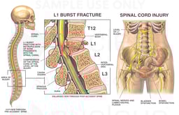 L1 Compression Burst Fracture with Spinal Cord Injury