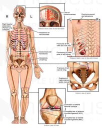 Female Figure with Brain Injury, Posterior Rib, Pelvic, and Left Knee Fractures