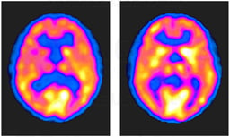 PET Scans Showing Axial View of the Brain