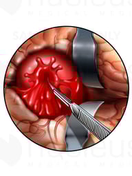 Rupture of Cerebral Artery