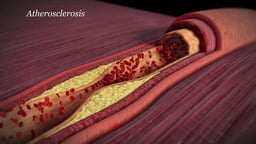 Narrowed Arterial Lumen in Atherosclerosis