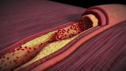 Atherosclerosis with Narrowed Arterial Lumen