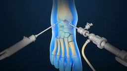 Ankle Arthroscopy (Scope)