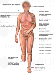 Anterior Female Figure with Multiple Surgeries and Medical Treatments Including BKA Amputation