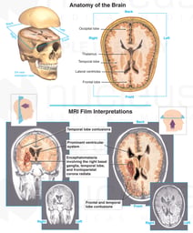 Current Brain Damage