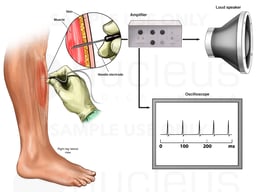 EMG of Right Lower Extremity