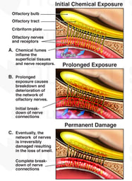 Olfactory Nerve Damage