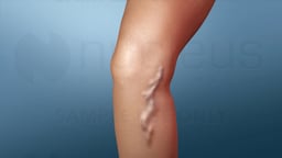 Treatment for Varicose Veins: Procedures