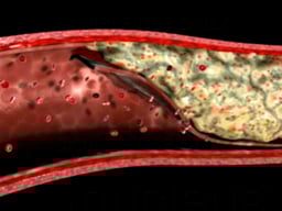 Blocked Artery Due to Thrombus Plaque Formation