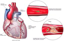 Coronary Artery Disease Leading to Fatal Heart Attack