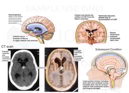 Colloid Cyst with Blockage of CSF Circulation