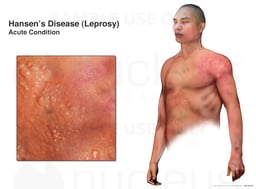 Hansen's Disease: Leprosy Acute Condition