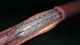 Coronary Artery Angioplasty (Radial Access)