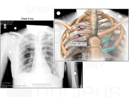 Right Rib Fractures
