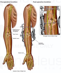 External Fixator Placement with Radial Nerve Damage
