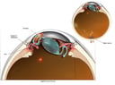 Blockage of Aqueous Fluid Flow
