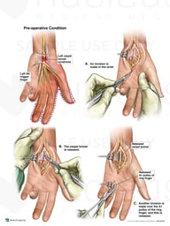 Left Carpal Tunnel Syndrome and Trigger Finger with Surgical Release