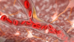 Microscopic View of Ischemic Stroke in Brain Blood Vessel