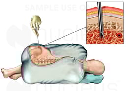 Bone Biopsy from the Iliac Crest