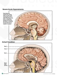 Severe Acute Hyponatremia vs. Actual Condition