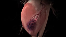 Myocardial Infarction with Coronary Artery Blockage