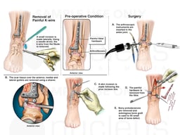 Hardware Removal Procedures