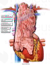 Anterior Mediastinal Mass